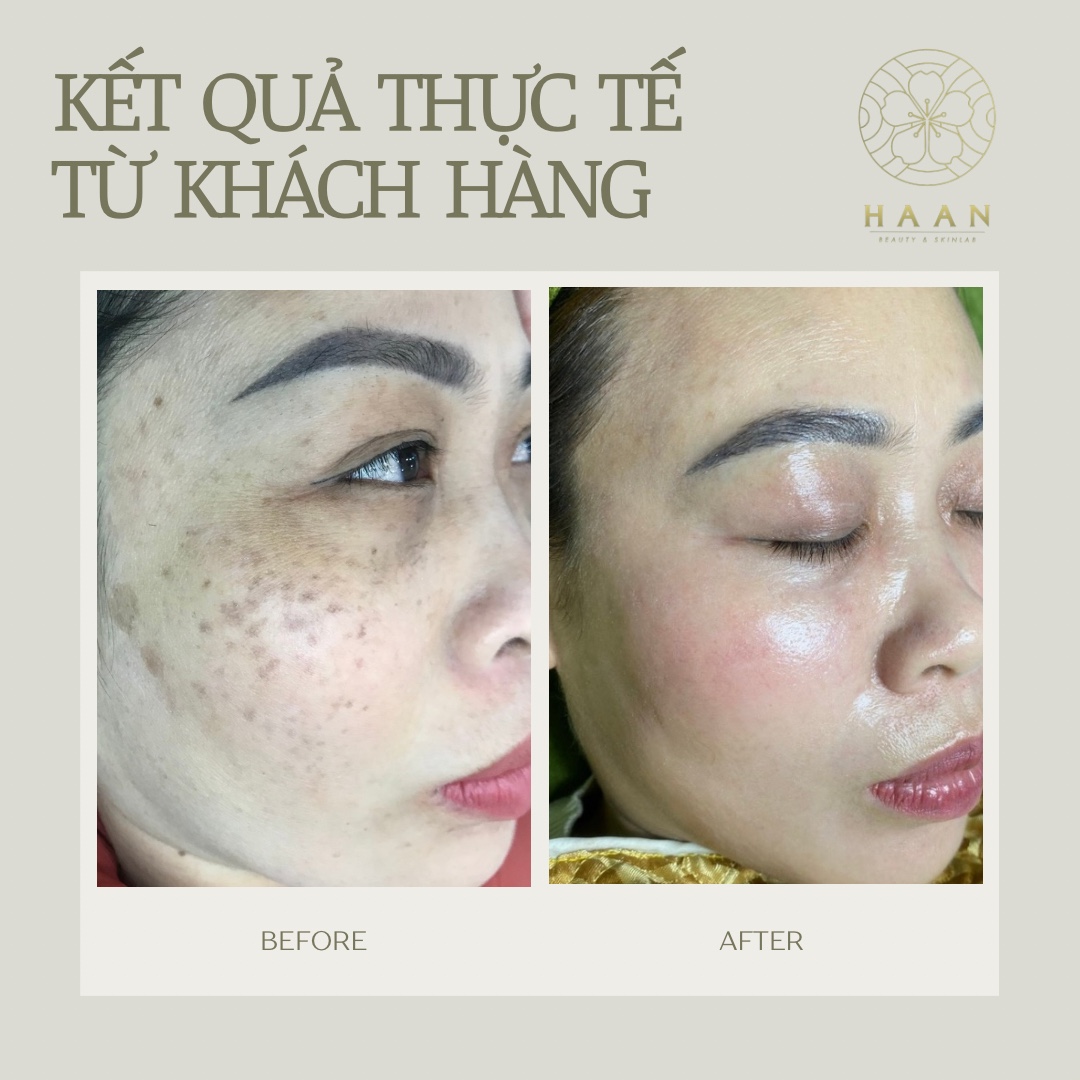 Ảnh trước và sau chăm sóc sắc tố của một khách hàng Hà An Beauty