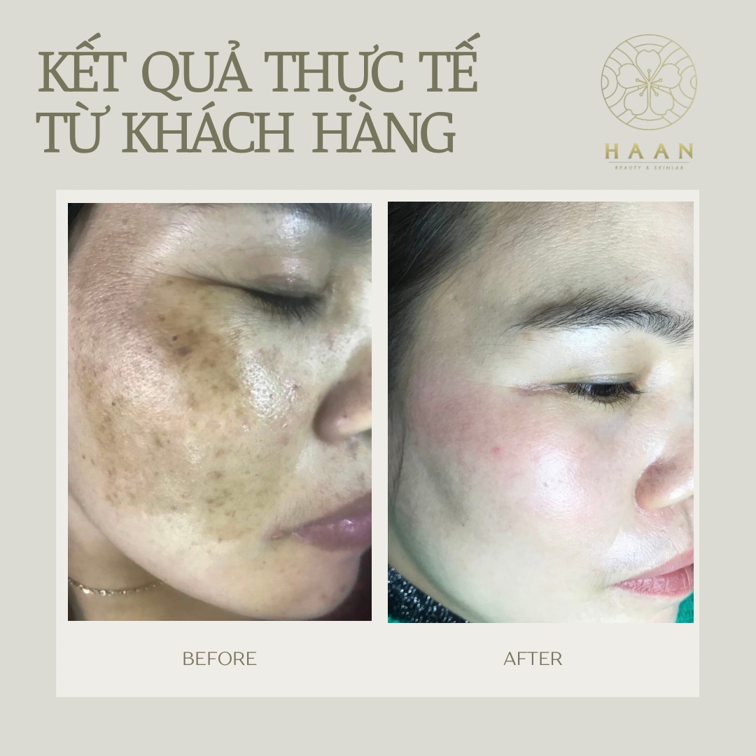 Ảnh trước và sau chăm sóc sắc tố của khách hàng khác