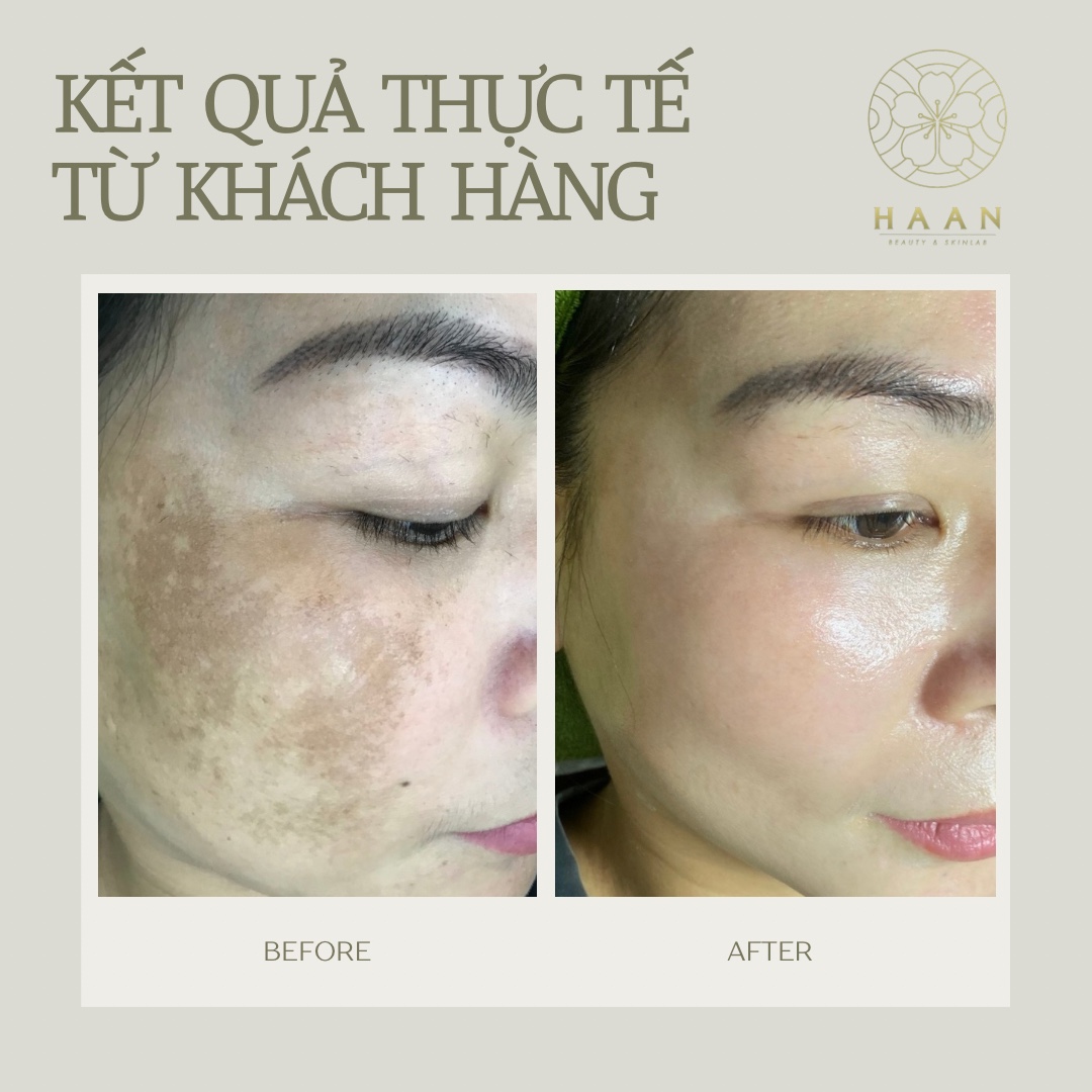 Ảnh trước và sau phục hồi và cải thiện bề mặt da