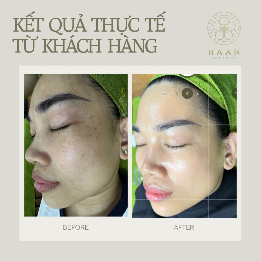Ảnh trước và sau chăm sóc tàn nhang của khách hàng Hà An Beauty, ca 1
