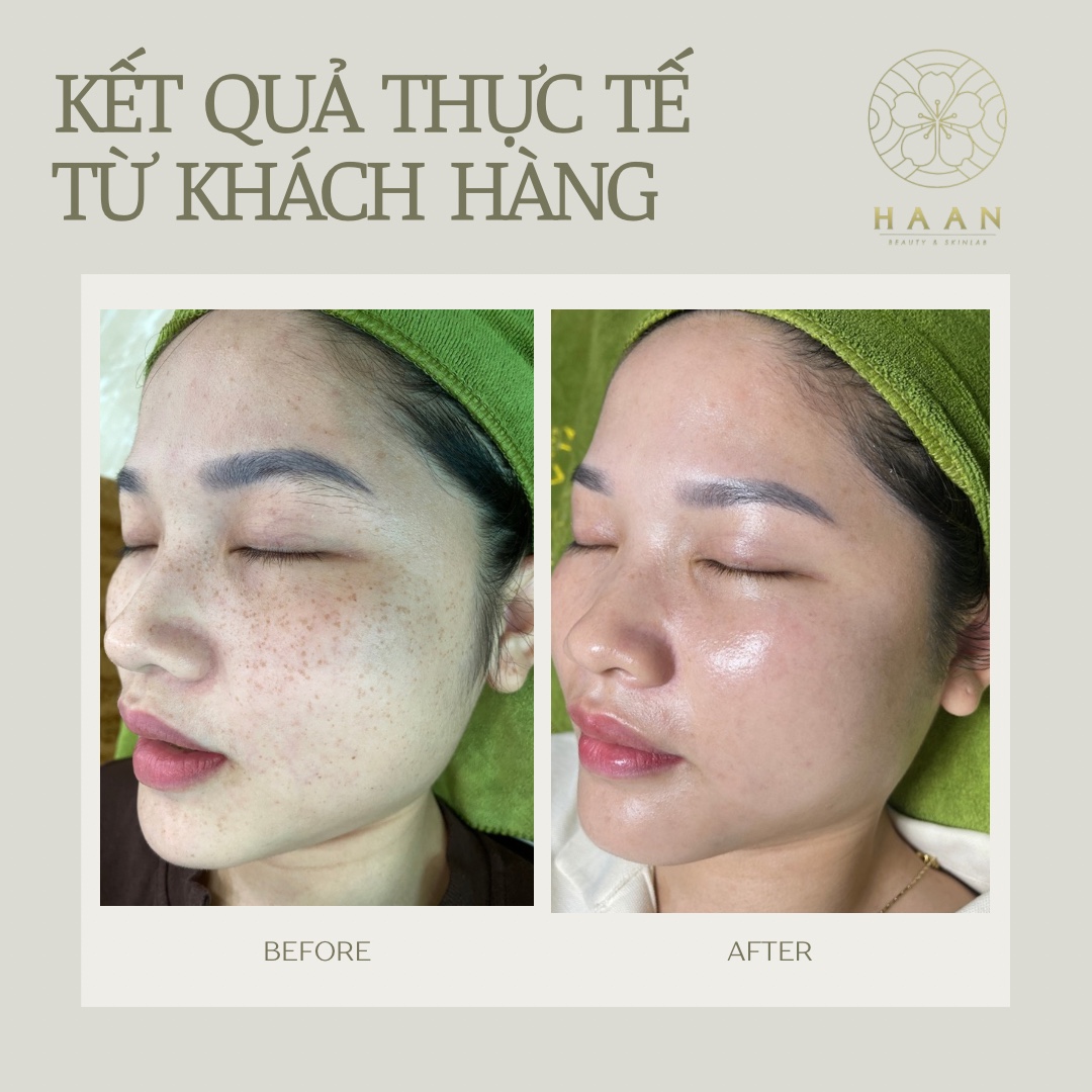 Ảnh trước và sau chăm sóc tàn nhang của khách hàng Hà An Beauty, ca 2