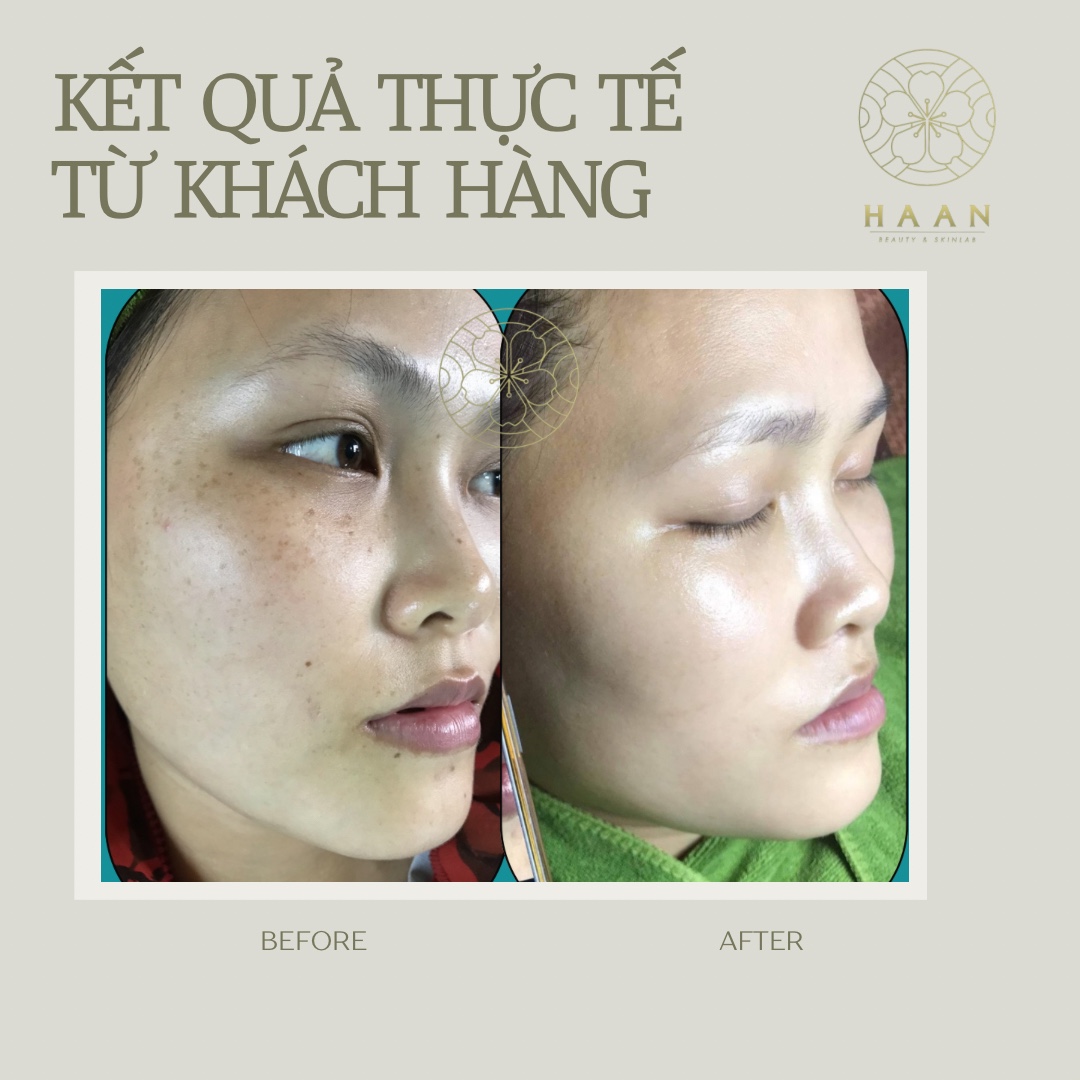 Ảnh trước và sau chăm sóc tàn nhang của khách hàng Hà An Beauty, ca 3