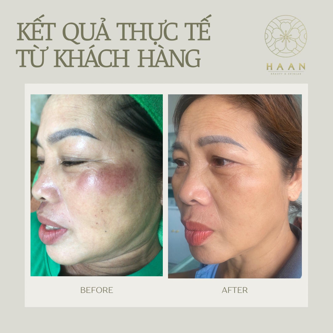 Ảnh trước và sau chăm sóc tình trạng tăng sắc tố của khách hàng Hà An Beauty