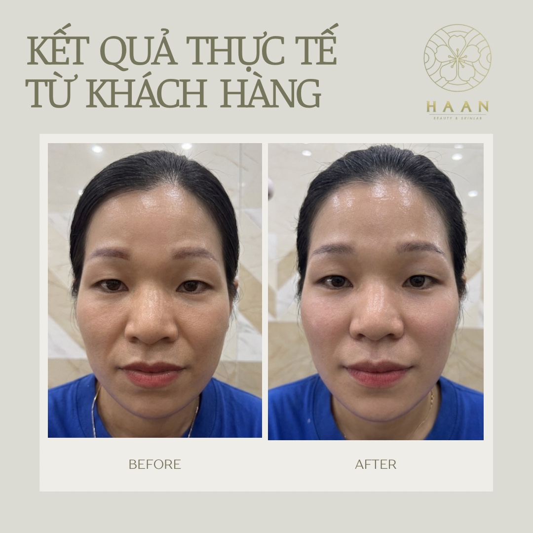 Ảnh trước và sau liệu trình trẻ hóa của khách hàng Hà An Beauty