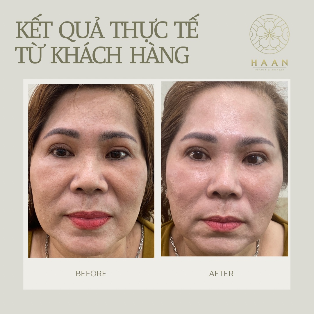 Ảnh trước và sau chăm sóc trẻ hóa của một khách hàng khác